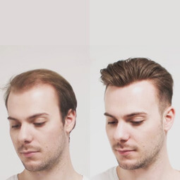 hair replacement Image